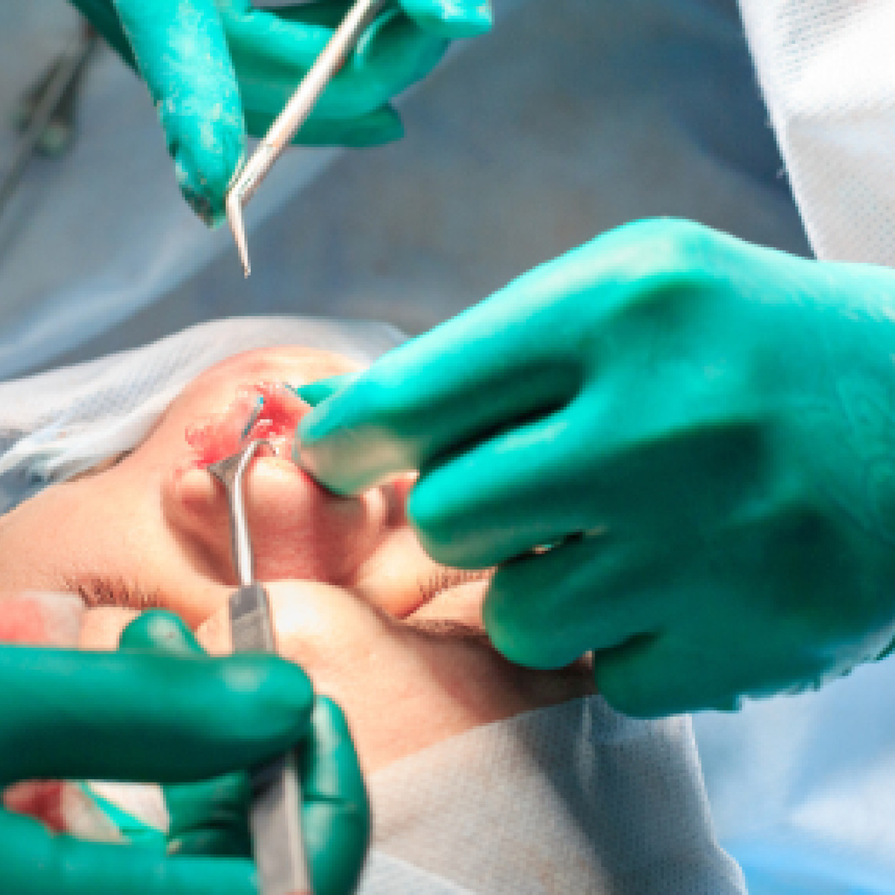 Septal Perforation Surgery London - Expert Treatment for Nasal Septum Perforation